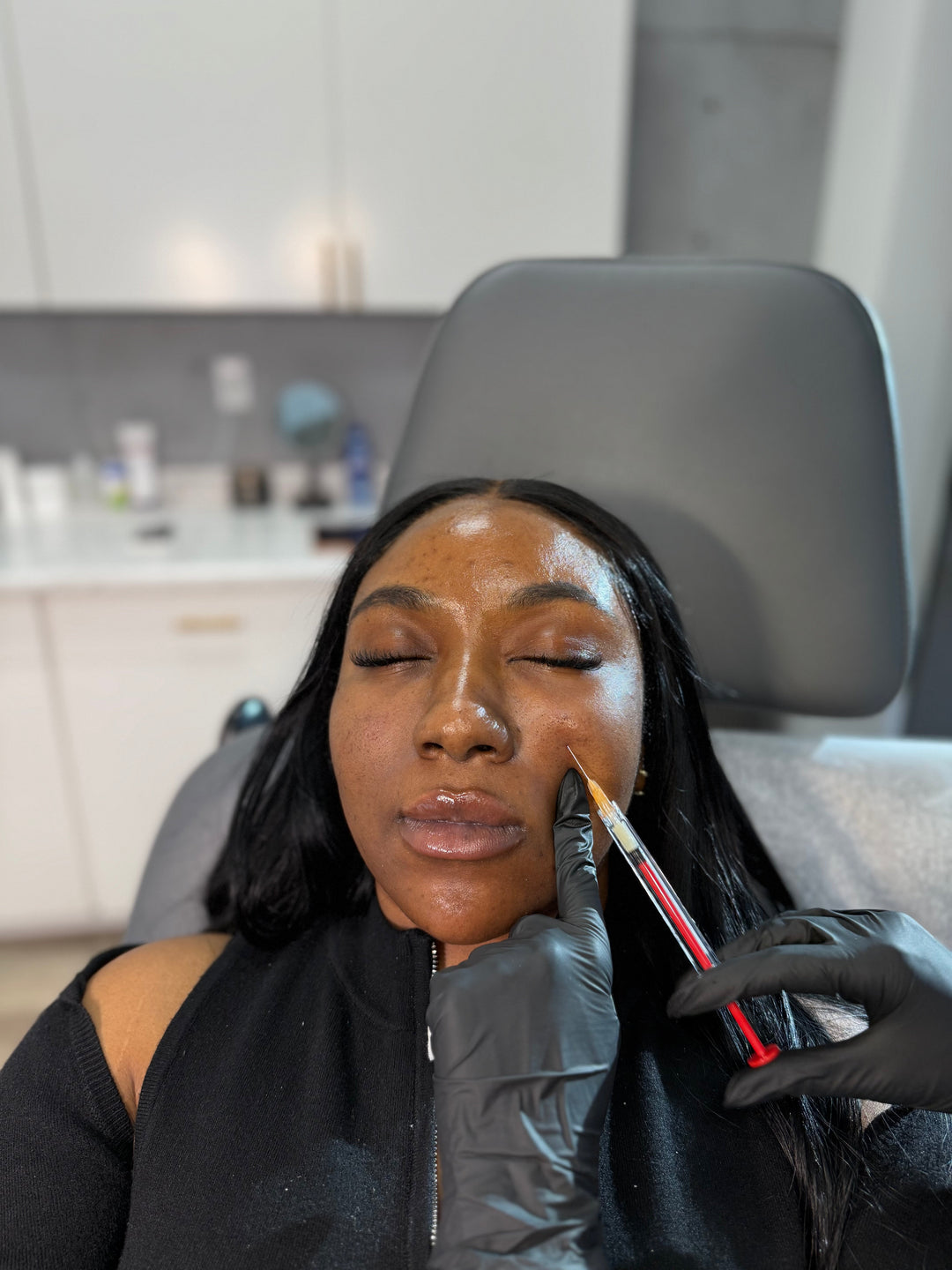 I Tried Collagen Injections For My Under Eyes