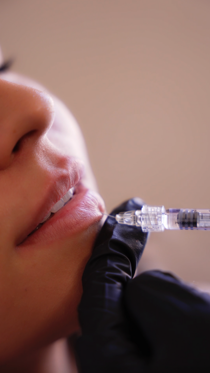 Half Syringe Lips + 40 units Tox