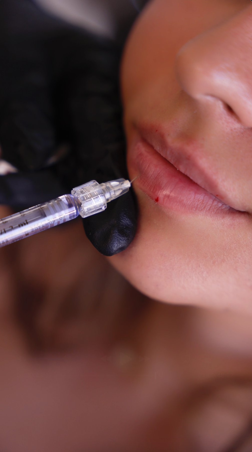 Half Syringe Lips + 40 units Tox