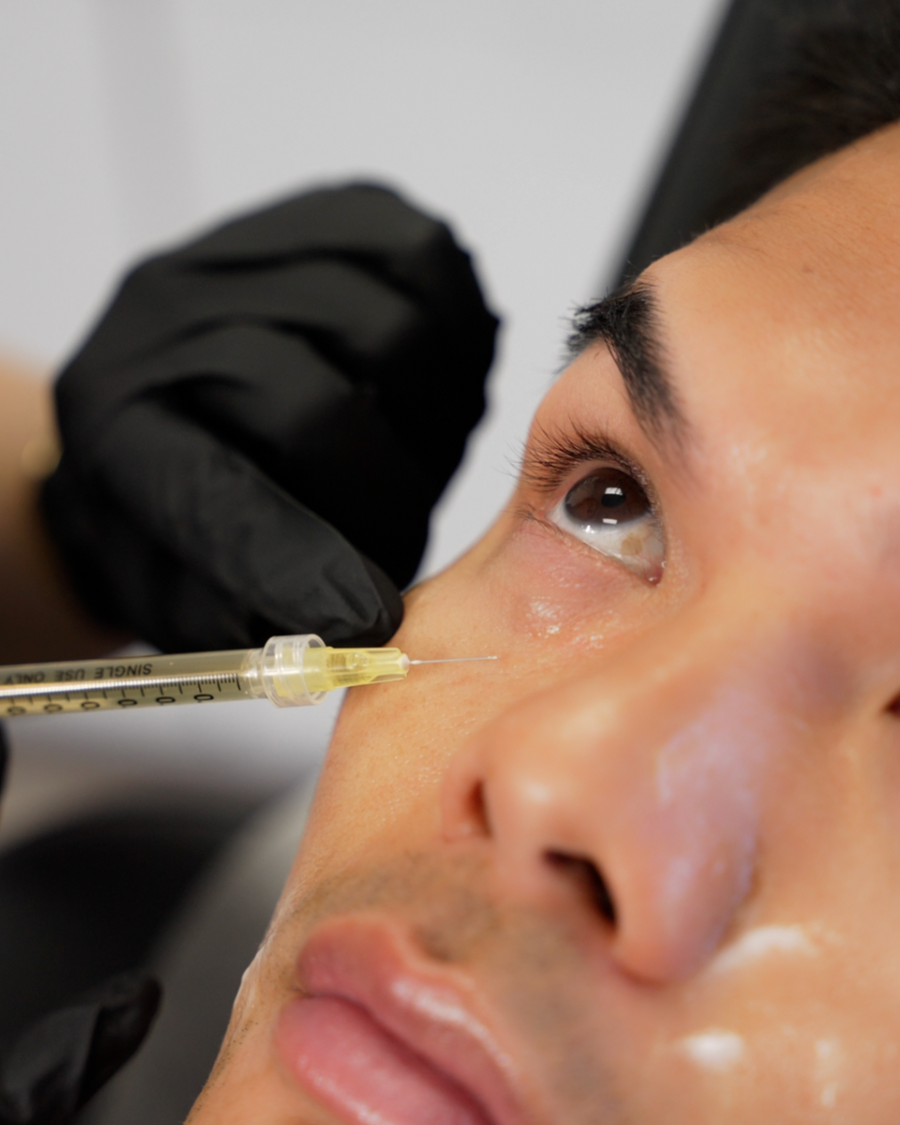 Simerly Eye Injection PRP Under Eye + Smile Lines Injections – ST MED SPA