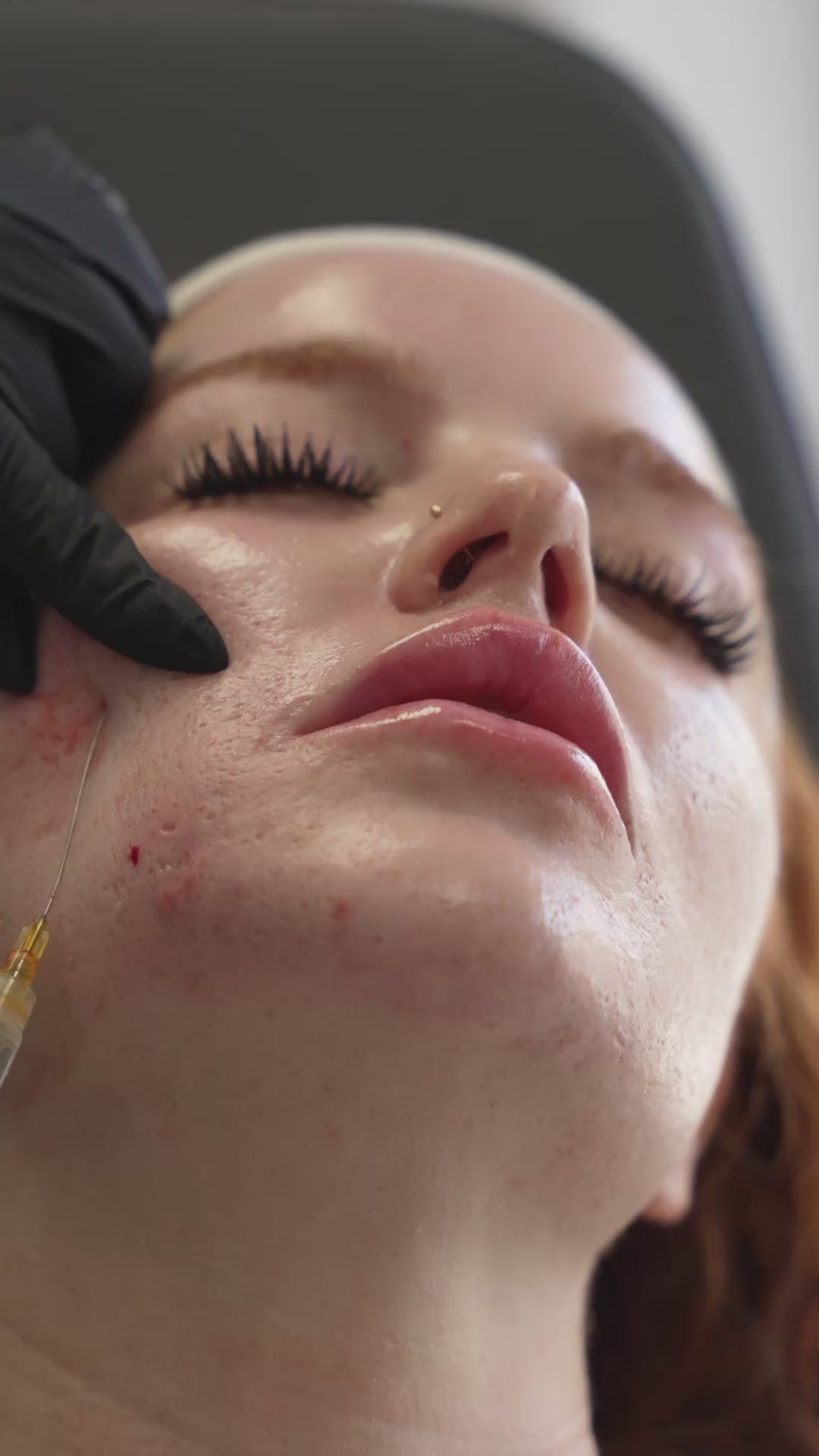 Subcision + PRP Micro-needling