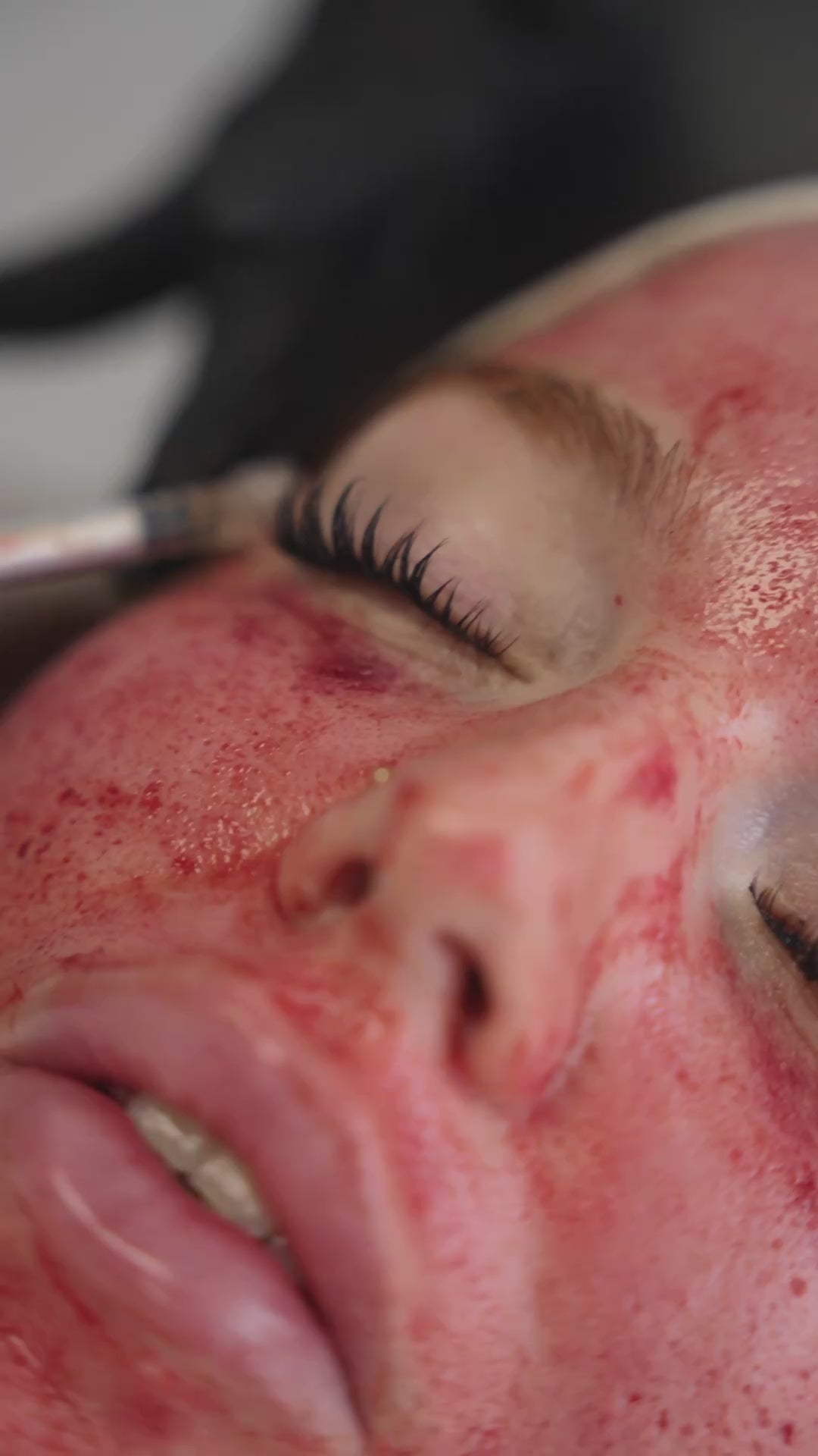 Subcision + PRP Micro-needling