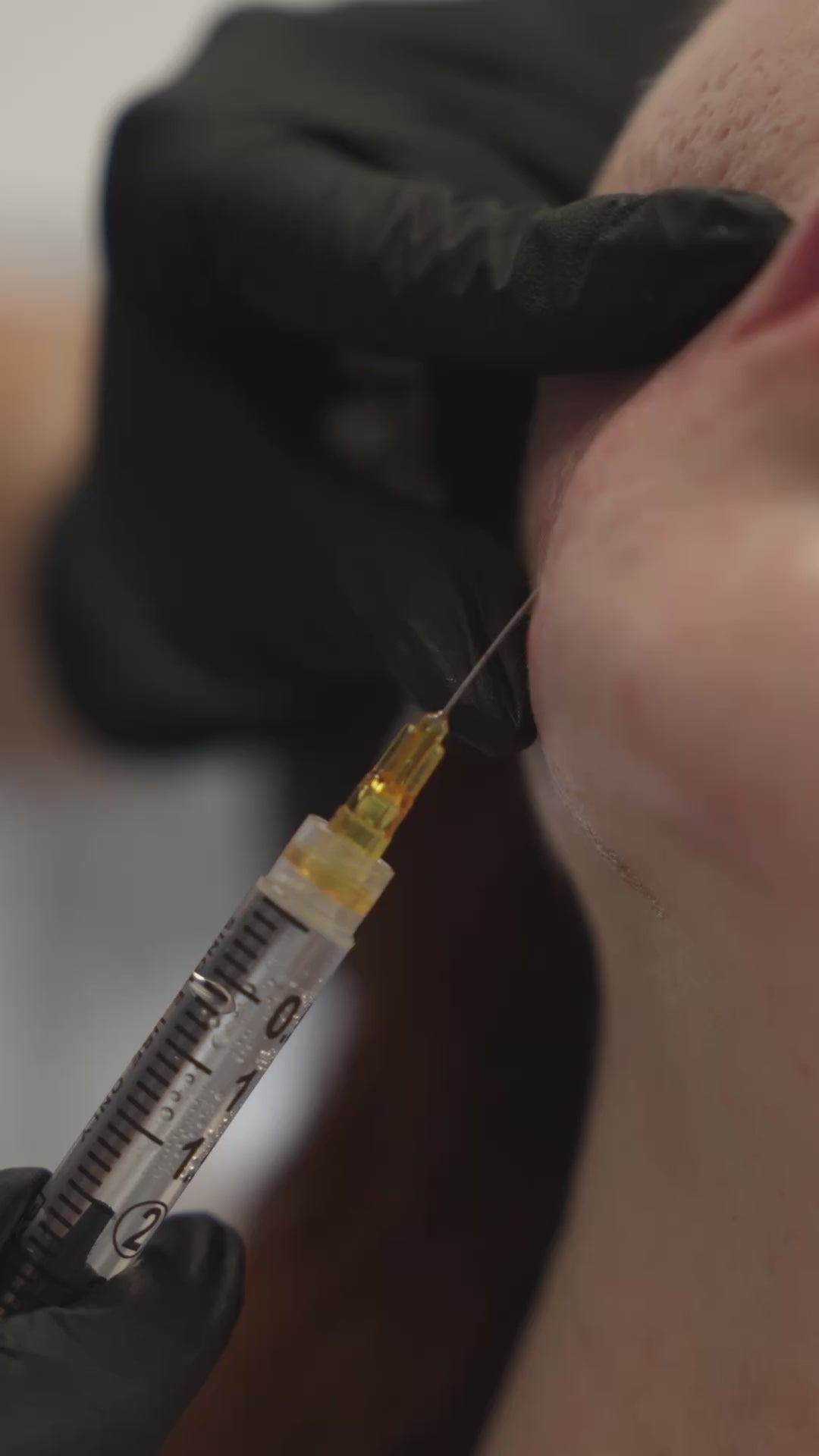 Subcision + PRP Micro-needling