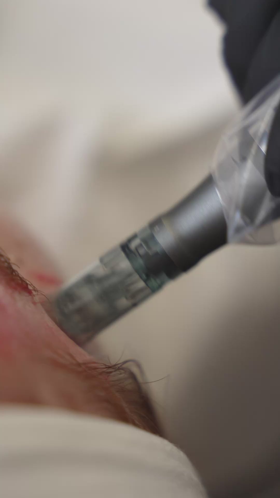 Subcision + PRP Micro-needling